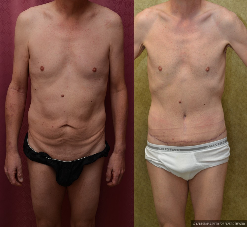 Male Tummy Tuck (abdominoplasty) Before & After Patient #13574