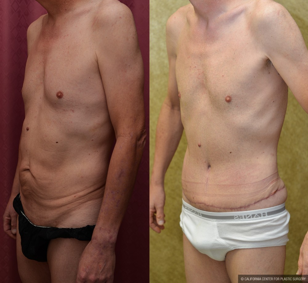 Male Tummy Tuck (abdominoplasty) Before & After Patient #13574