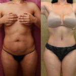 Tummy Tuck (Abdominoplasty) Medium Size Before & After Patient #13566