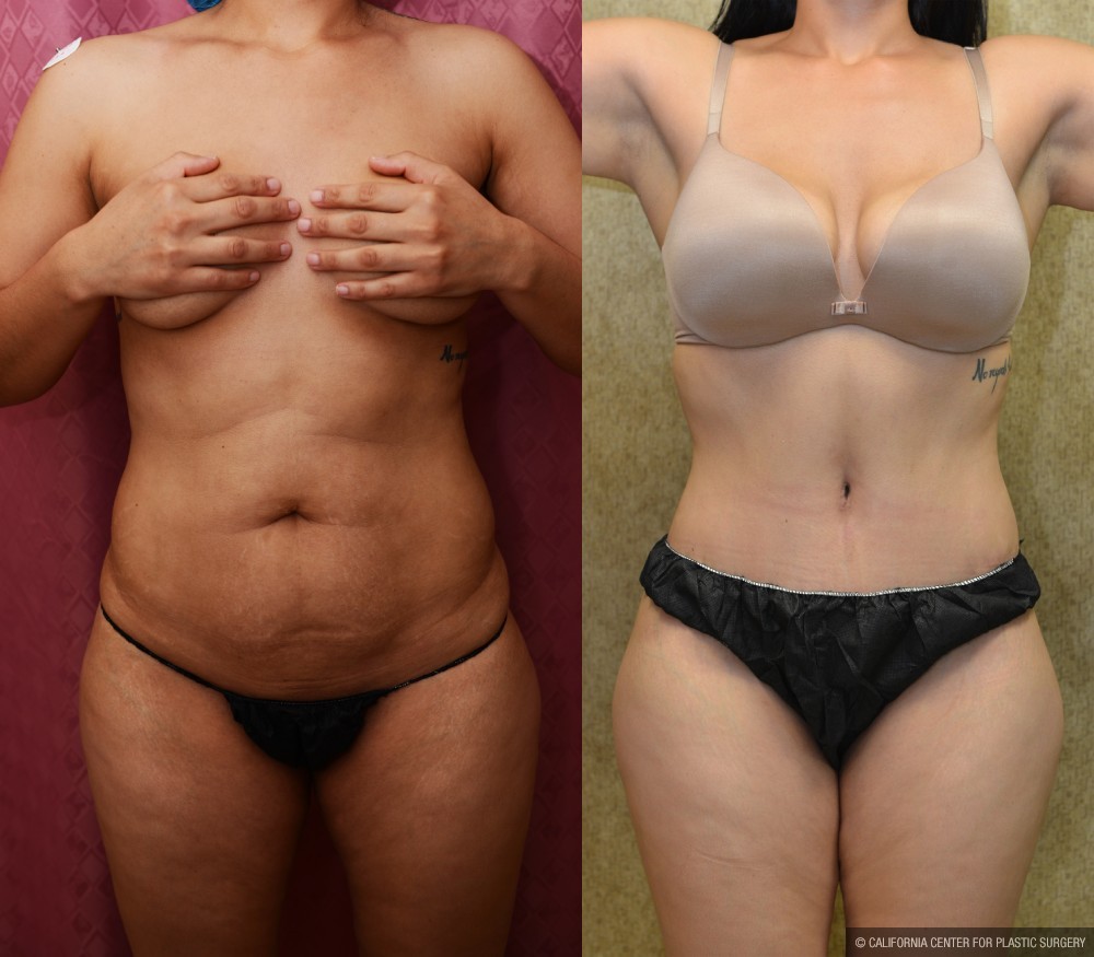 Tummy Tuck (Abdominoplasty) Medium Size Before & After Patient #13566