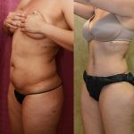 Tummy Tuck (Abdominoplasty) Medium Size Before & After Patient #13566