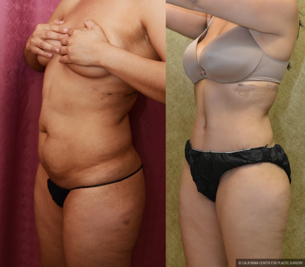 Tummy Tuck (Abdominoplasty) Medium Size Before & After Patient #13566