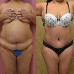 Tummy Tuck (Abdominoplasty) Medium Size Before & After Patient #13554