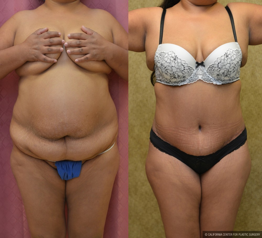 Tummy Tuck (Abdominoplasty) Medium Size Before & After Patient #13554