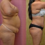 Tummy Tuck (Abdominoplasty) Medium Size Before & After Patient #13554