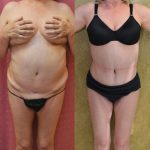 Tummy Tuck (Abdominoplasty) Medium Size Before & After Patient #13559