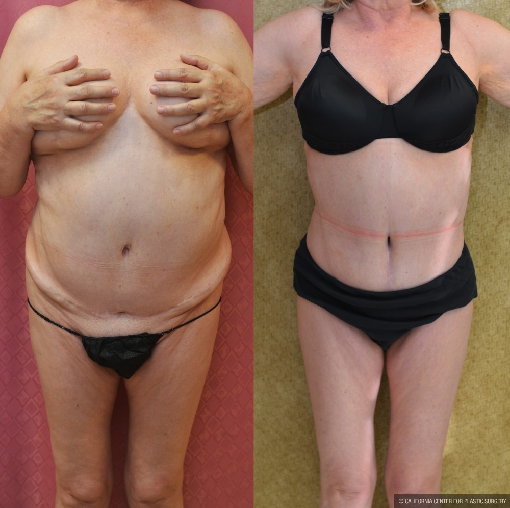 Tummy Tuck (Abdominoplasty) Medium Size Before & After Patient #13559