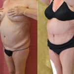 Tummy Tuck (Abdominoplasty) Medium Size Before & After Patient #13559