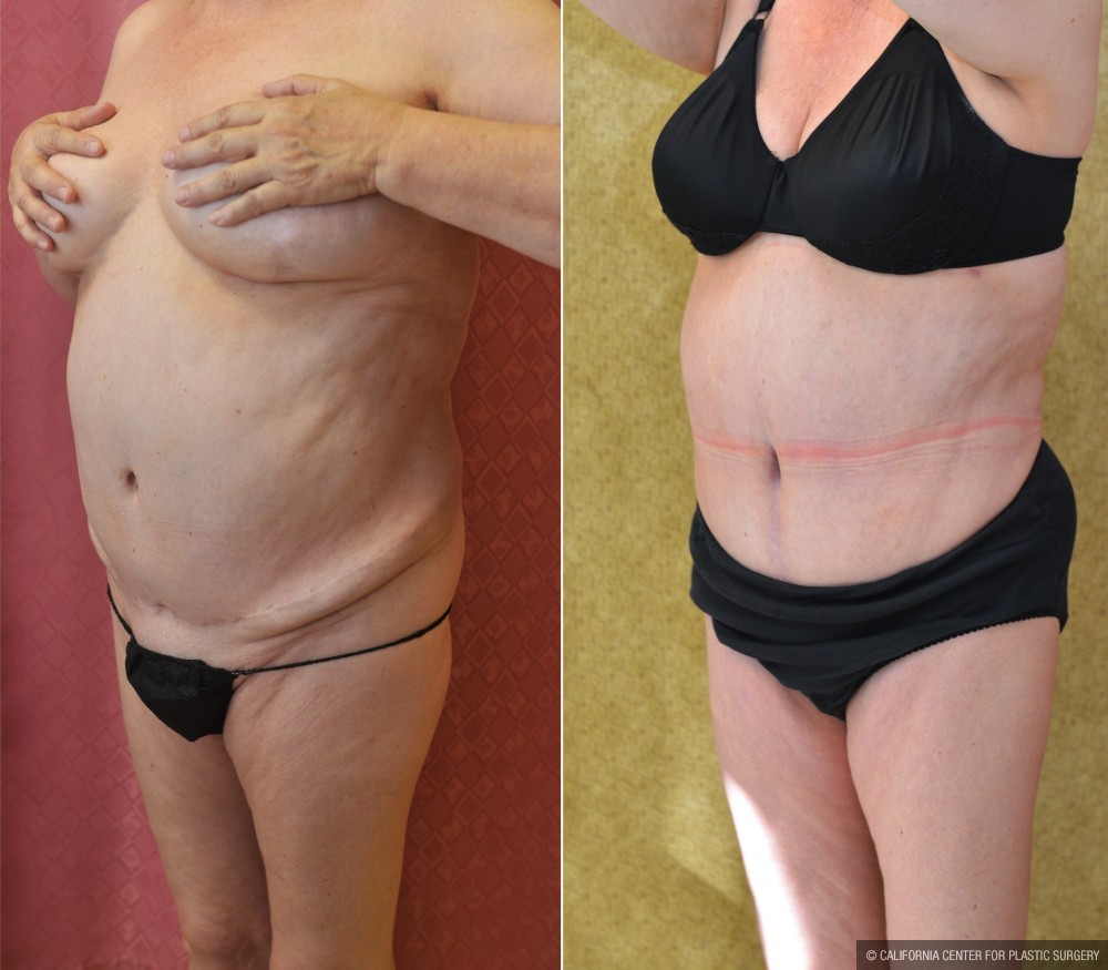 Tummy Tuck (Abdominoplasty) Medium Size Before & After Patient #13559