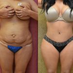 Tummy Tuck (Abdominoplasty) Medium Size Before & After Patient #13562