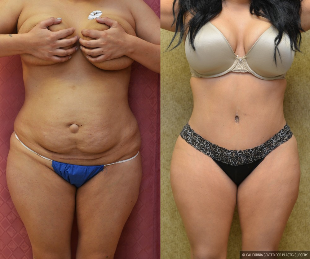 Tummy Tuck (Abdominoplasty) Medium Size Before & After Patient #13562