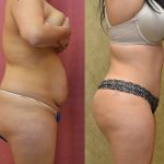 Tummy Tuck (Abdominoplasty) Medium Size Before & After Patient #13562