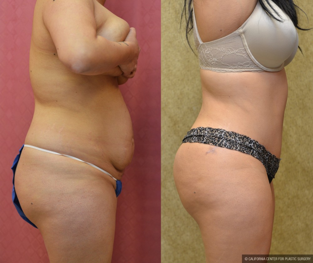 Tummy Tuck (Abdominoplasty) Medium Size Before & After Patient #13562