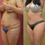 Tummy Tuck (Abdominoplasty) Medium Size Before & After Patient #13562