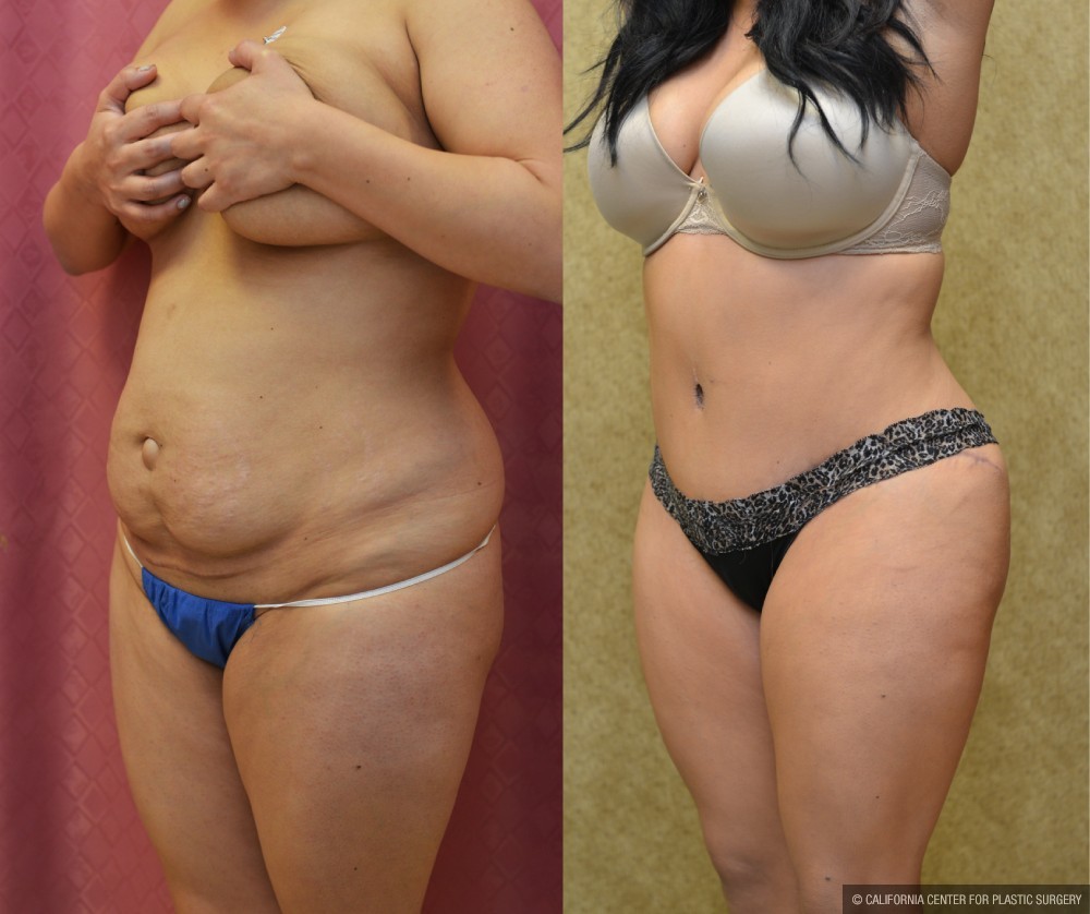 Tummy Tuck (Abdominoplasty) Medium Size Before & After Patient #13562