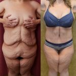 Tummy Tuck (Abdominoplasty) Super Plus Size Before & After Patient #13629