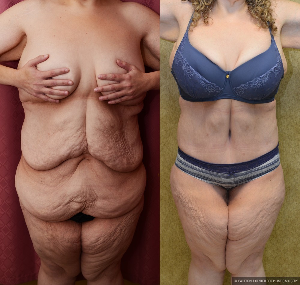 Tummy Tuck (Abdominoplasty) Super Plus Size Before & After Patient #13629
