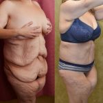 Tummy Tuck (Abdominoplasty) Super Plus Size Before & After Patient #13629