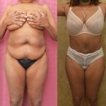 Tummy Tuck (Abdominoplasty) Medium Size Before & After Patient #13570