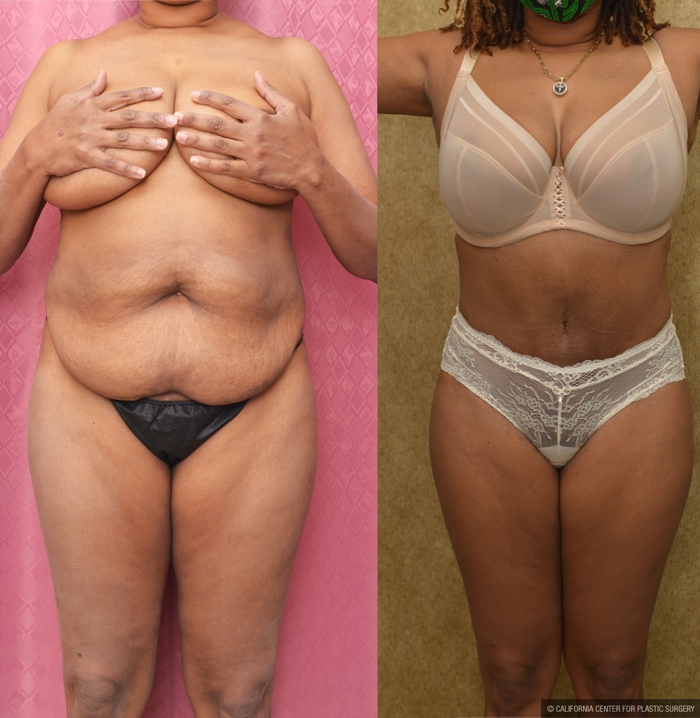 Tummy Tuck (Abdominoplasty) Medium Size Before & After Patient #13570