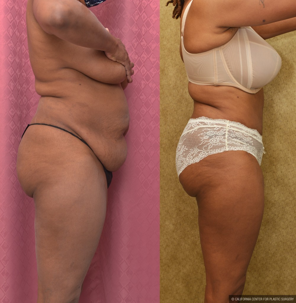 Tummy Tuck (Abdominoplasty) Medium Size Before & After Patient #13570