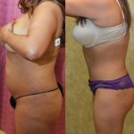 Tummy Tuck (Abdominoplasty) Medium Size Before & After Patient #13550