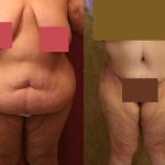 Tummy Tuck (Abdominoplasty) Super Plus Size Before & After Patient #13602