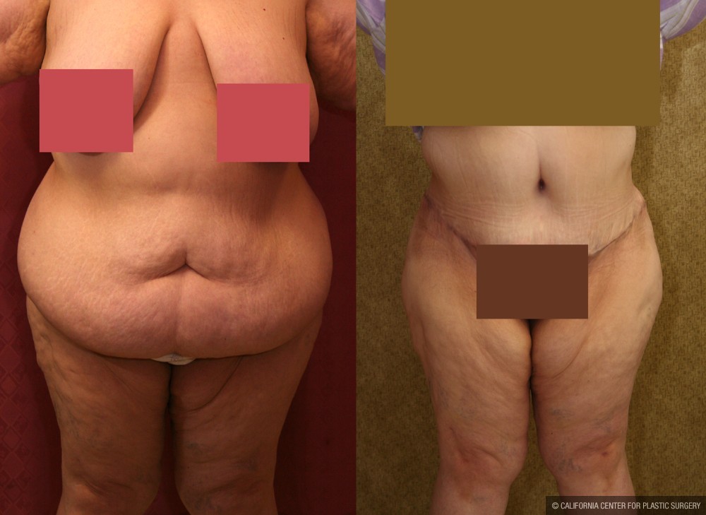 Tummy Tuck (Abdominoplasty) Super Plus Size Before & After Patient #13602
