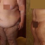 Tummy Tuck (Abdominoplasty) Super Plus Size Before & After Patient #13602