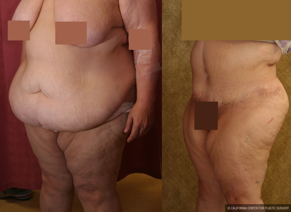 Tummy Tuck (Abdominoplasty) Super Plus Size Before & After Patient #13602