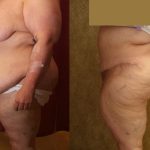 Tummy Tuck (Abdominoplasty) Super Plus Size Before & After Patient #13602