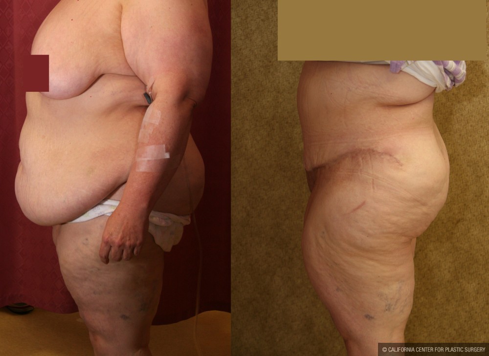 Tummy Tuck (Abdominoplasty) Super Plus Size Before & After Patient #13602