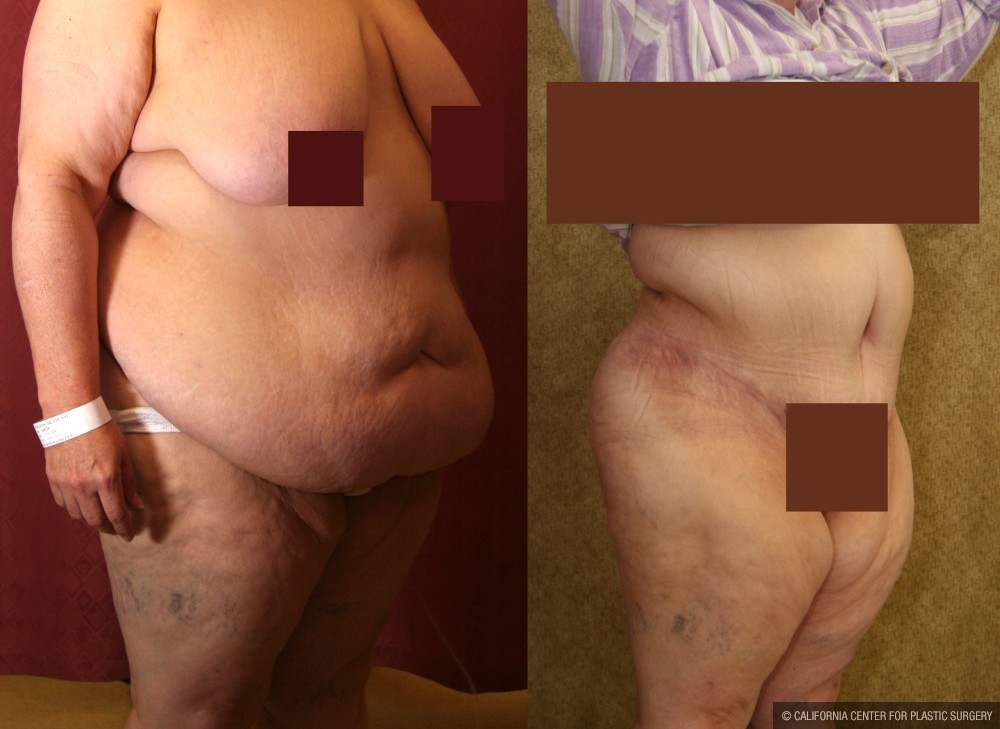 Tummy Tuck (Abdominoplasty) Super Plus Size Before & After Patient #13602