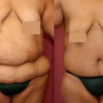 Tummy Tuck (Abdominoplasty) Super Plus Size Before & After Patient #13642