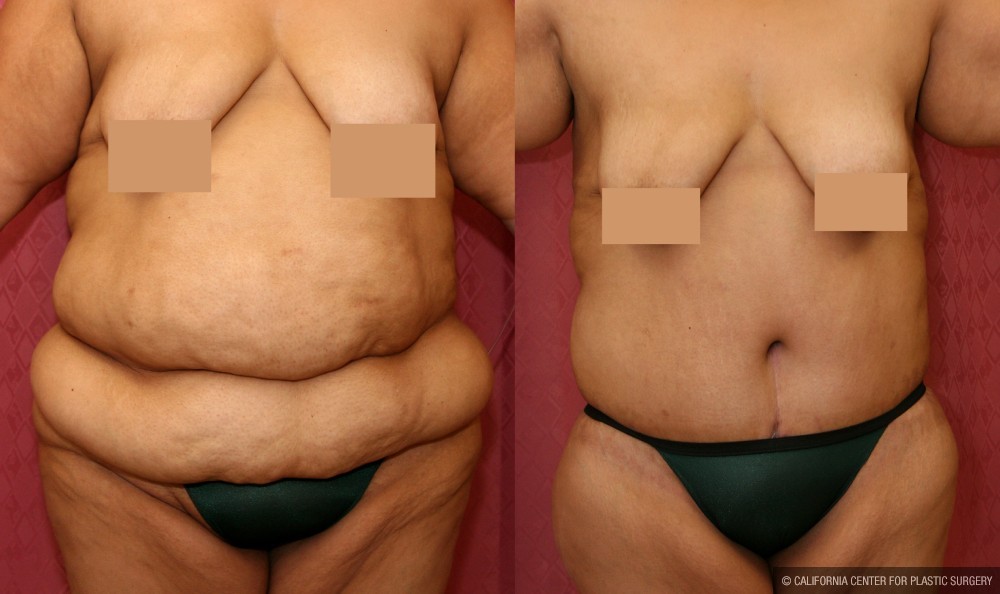 Tummy Tuck (Abdominoplasty) Super Plus Size Before & After Patient #13642