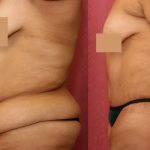 Tummy Tuck (Abdominoplasty) Super Plus Size Before & After Patient #13642