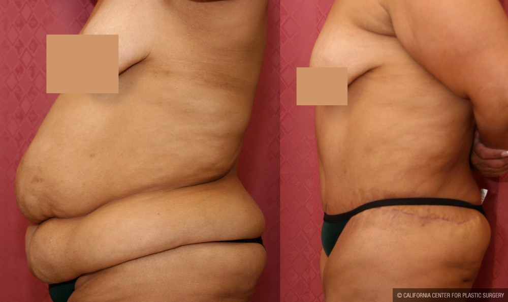 Tummy Tuck (Abdominoplasty) Super Plus Size Before & After Patient #13642