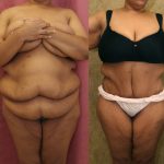 Tummy Tuck (Abdominoplasty) Super Plus Size Before & After Patient #13637