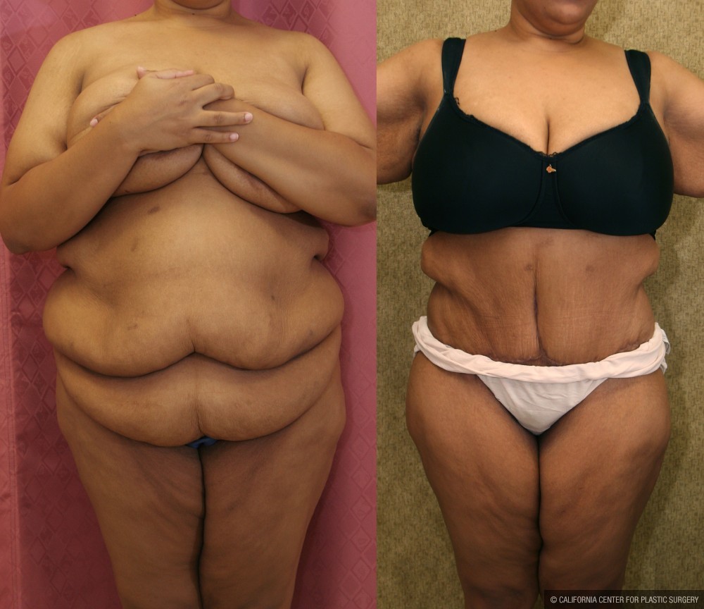 Tummy Tuck (Abdominoplasty) Super Plus Size Before & After Patient #13637