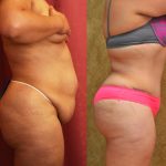 Tummy Tuck (Abdominoplasty) Medium Size Before & After Patient #13546