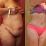Tummy Tuck (Abdominoplasty) Medium Size Before & After Patient #13546