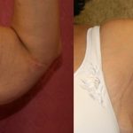 Arm Lift (Brachioplasty) Before & After Patient #13665