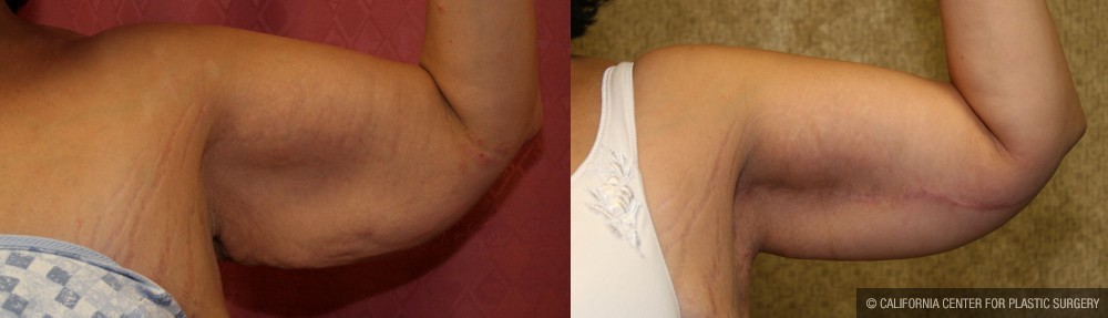 Arm Lift (Brachioplasty) Before & After Patient #13665