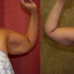 Arm Lift (Brachioplasty) Before & After Patient #13665