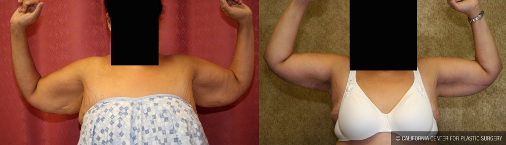 Arm Lift (Brachioplasty) Before & After Patient #13665