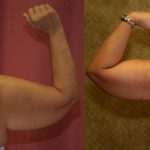 Arm Lift (Brachioplasty) Before & After Patient #13665