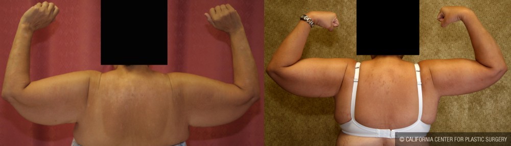 Arm Lift (Brachioplasty) Before & After Patient #13665