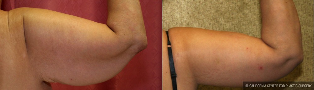 Arm Lift (Brachioplasty) Before & After Patient #13665