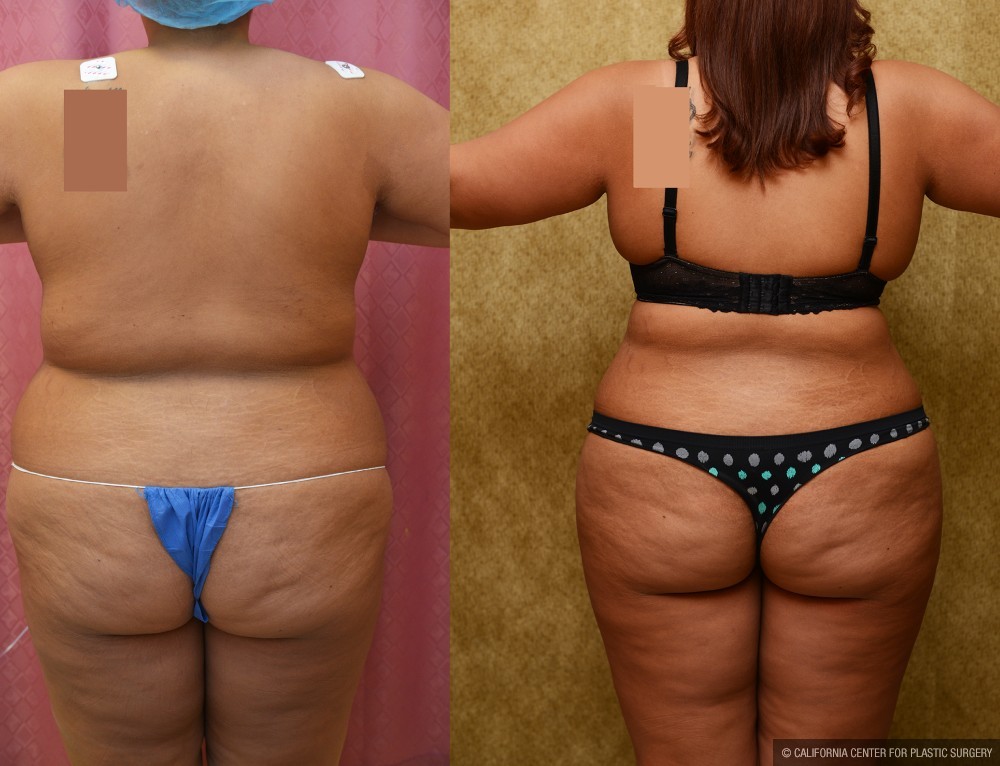 Liposuction Abdomen Plus Size Before & After Patient #13534