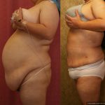 Liposuction Abdomen Plus Size Before & After Patient #13529